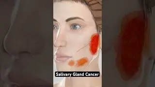 Cancer in your salivary glands (3D Animation)