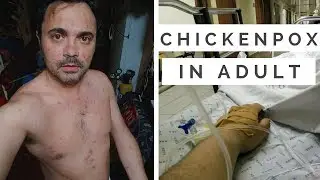 CHICKENPOX IN ADULT | Varicella, my experience