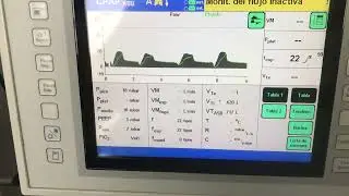 CPAP/ASB o respiración espontánea asistida con presión de soporte