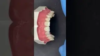SUPER LIVE 2 CANINO E PRÉ MOLAR FACETAS EM RESINA - GLAUCO MENEZES