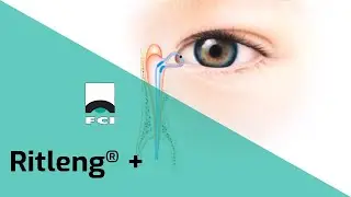 Ritleng®+ | Intubation bicanaliculo-nasale autostable | DCR | Larmoiement | FCI