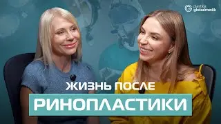 Alena America | Rhinoplasty in Istanbul – What's the Recovery Like? Personal Experience | Podcast...