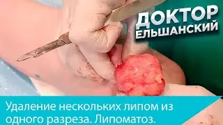 Удаление нескольких липом из одного разреза при липоматозе