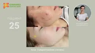25. Акне среднетяжёлая степень (до и после)