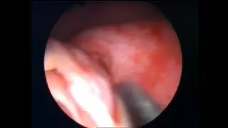 Endoscopic Trans-ureteral ureterovesical reimplantation