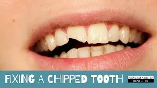 Repairing a Chipped Tooth
