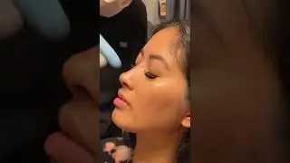 Non-Surgical Rhinoplasty + Chin Filler for Defined Jawline and Perkier Nose Tip!