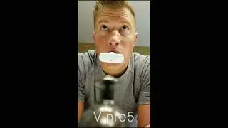 Dr. O's 1st Day of Accelerated Invisalign