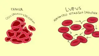 Lupus Myths vs Facts by LupusChick.com