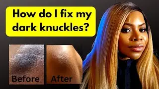 Doc, How Do I Lighten My Dark Elbows Without Bleaching My Skin? 😳