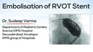 Embolisation of RVOT Stent