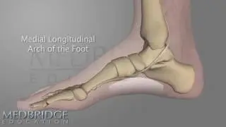 Posterior Tibial Tendon Dysfunction | MedBridge