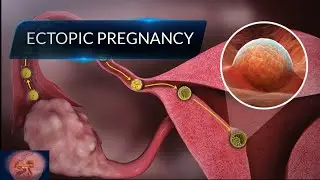 Ectopic Pregnancy | What Causes Ectopic Pregnancy | Ectopic Pregnancy Animation |