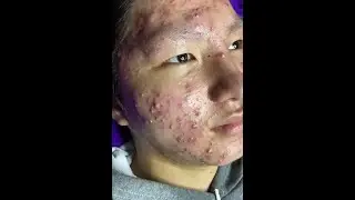 Treatment of acne tablets, pustules and blackheads #SHORTS