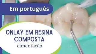 Onlay em resina composta - parte 5 (final): cimentação.