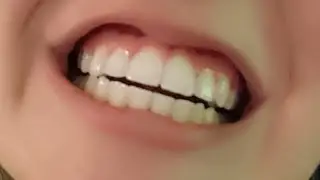 [4K] 14 Month Update/ Taking OFF My Braces! FULL Process