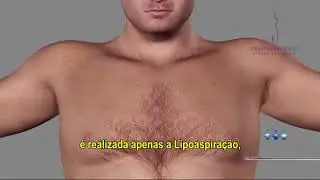 GINECOMASTIA - Dra. Débora Tomatis Pacheco - Cirurgia Plástica - Porto Alegre/RS