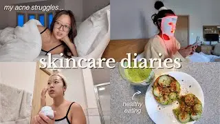 skincare diaries | my current routine, acne struggles, what i eat for clear skin