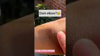 Dark Elbow? try this Remedy🔥🔥 
