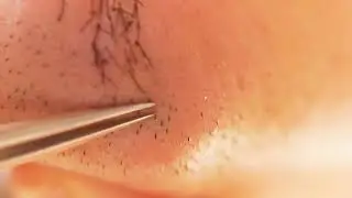 Hair removal asmr pull out with Tweezers  Satisfying pull out beard 10min 202408a