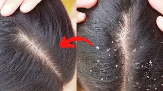 🔥#1 HOW TO TREAT DANDRUFF AT HOME | How to get rid of Dandruff | Dandruff  Home Remedies