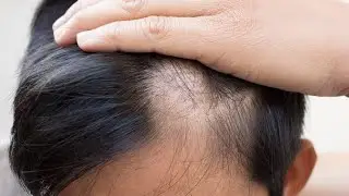 क्या झड़े बाल वापस आते है #haircare #shorts #ftkesariyshorts