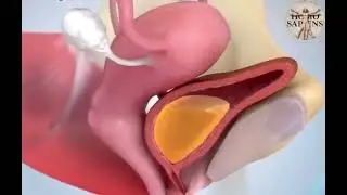Нима учун аёлларда цистит копрок учрайди?