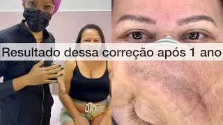 Micropigmentação com camuflagem após remoção a laser