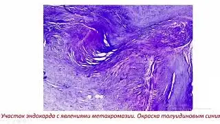 Стромально-сосудистые #дистрофии #патанатомия. Классификация. Мукоидное набухание.