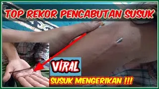 Top Rekor Melepas Susuk Panjang Dan Besar | Ruqyah | Membuang Energi Negatif