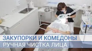 Закупорки и комедоны.   Ручная чистка лица