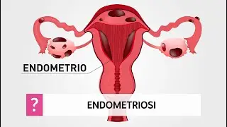 Endometriosi: cause, sintomi e diagnosi