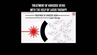 Treatment of varicose veins with the help of laser therapy #varicoseveinstreatment #varicoseveins