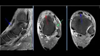 MRI Ankle Case 08