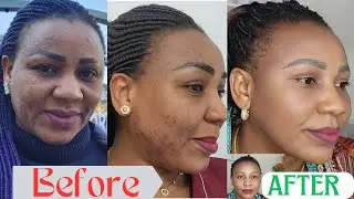How I Got Rid of My Acne *1 products that changed my life* | My Skin Reaction to Canada Weather