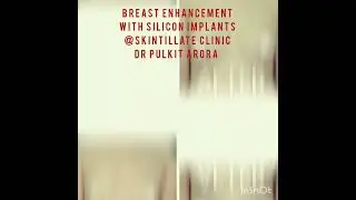 BREAST ENHANCEMENT WITH SILICONE IMPLANTS RESULTS