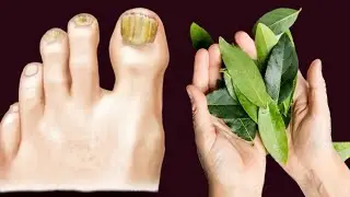 Nail Fungus Removal: 100% Natural Treatment For Toenail Fungus