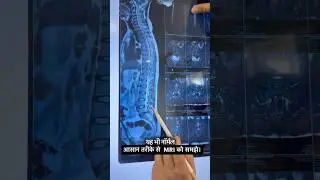 Understand  spine MRI in easy way by dr harish grover 