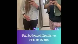 Türkiyədən gələn pasientimizin dəyişimi😍 #keşfet #plastikcerrahi #youtubeshorts #love