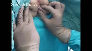 fistula problem in young girl child