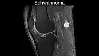 Schwannoma
