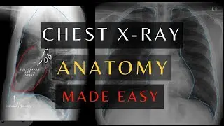 How to Read Chest X-ray Anatomy | Learn Basic Chest Anatomy fast. 