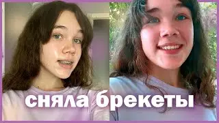 мне сняли брекеты! (и удалили зуб мудрости)