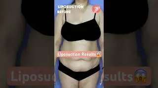 Liposuction Surgery Before After | Liposuction Before and After | Liposuction Result | SB Aesthetics