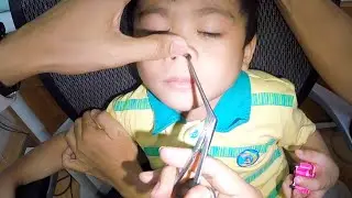 Removing A Foam Stuck in Boy's Nose