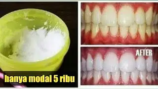 TAK USAH KE DOKTER ..!! CARA MEMUTIHKAN GIGI SECARA ALAMI, HITUNGAN MENIT GIGI KUNING LANGSUNG PUTIH