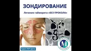 Зондирование верхнечелюстных пазух.