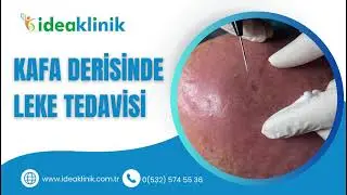 Kafa Derisinde Leke Tedavisi Nasıl Yapılır? (Ameliyatsız) - IDEA Klinik