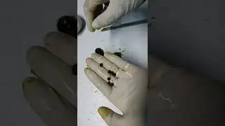 Gall Bladder Stones Dissection. பித்தப்பை கற்கள் #essenceworld