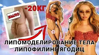 ШОК😎Липомоделирование и липофилинг ягодиц📌Моя история! #липофилинг #липосакция